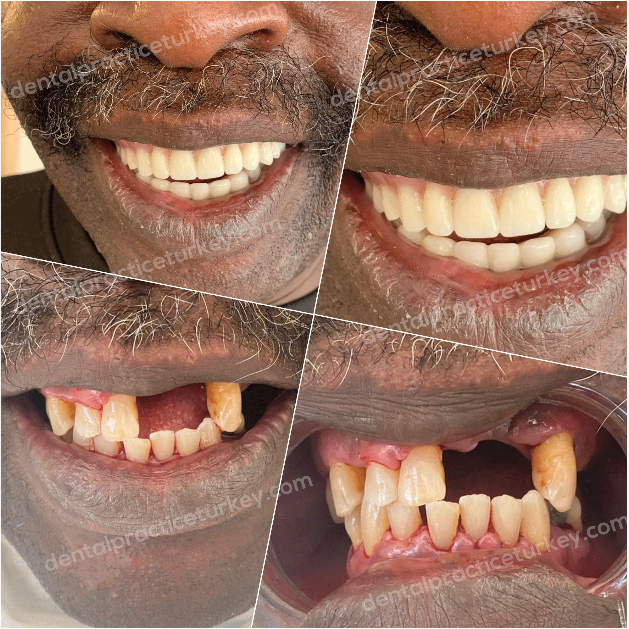 Dental Implants before after 4