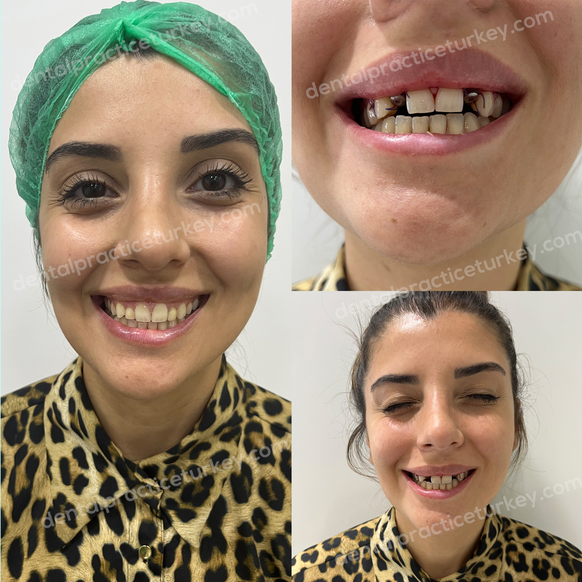 Dental Implants before after 5