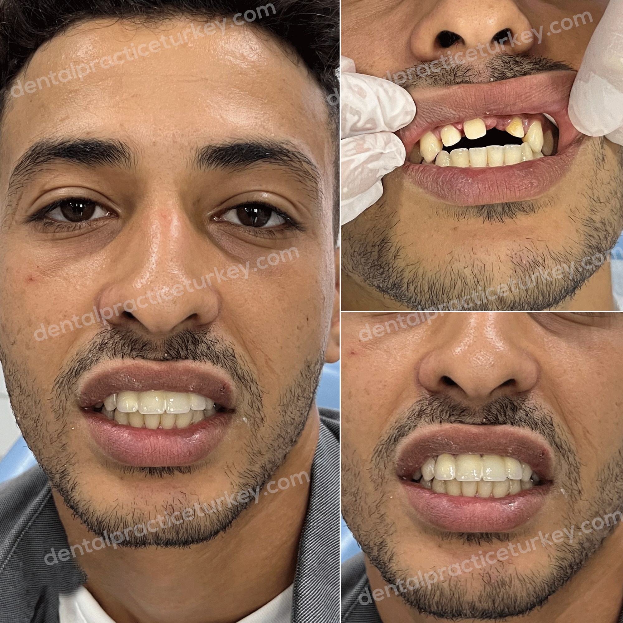 Dental Implants before after 1
