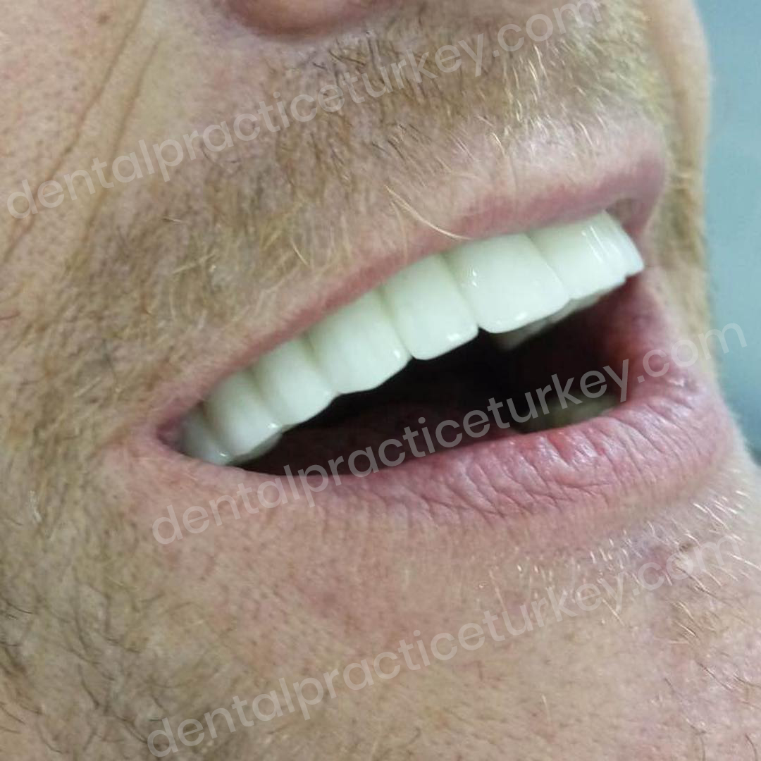 Full Mouth Dental Implants 3