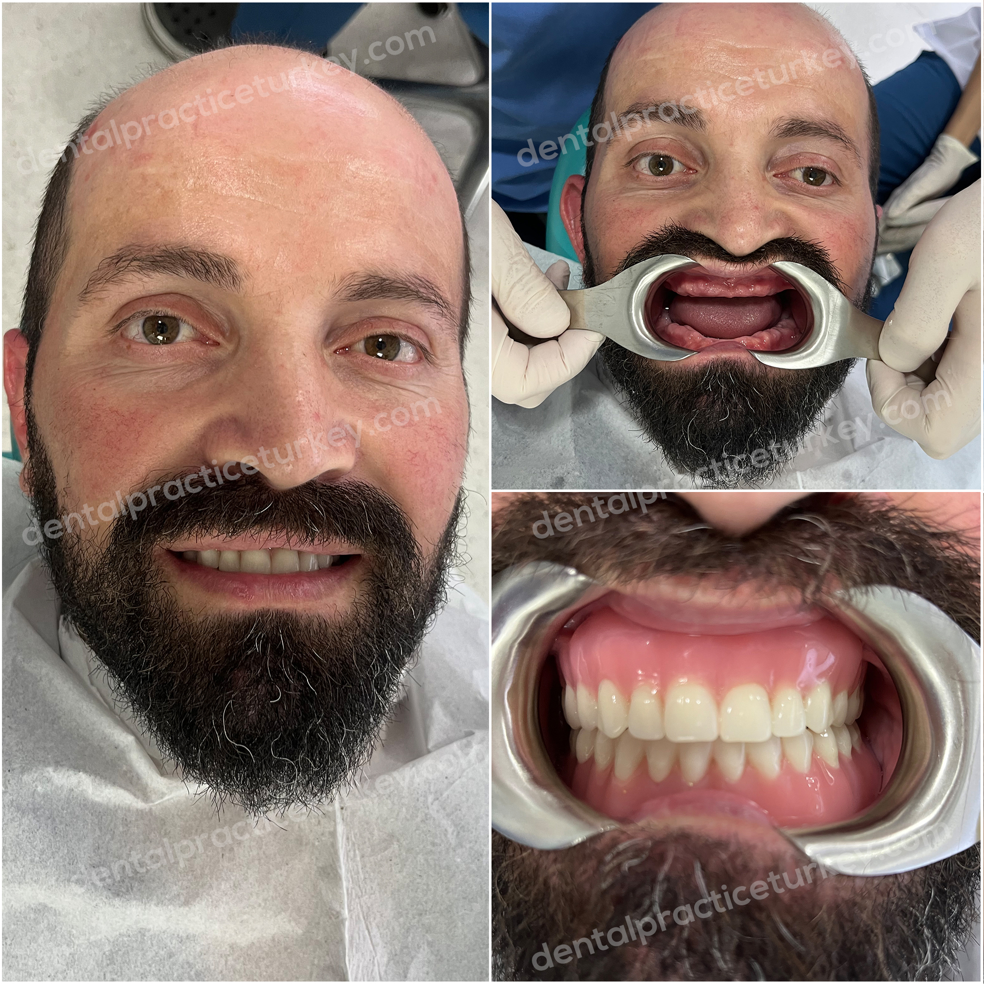 Full Mouth Dental Implants 3