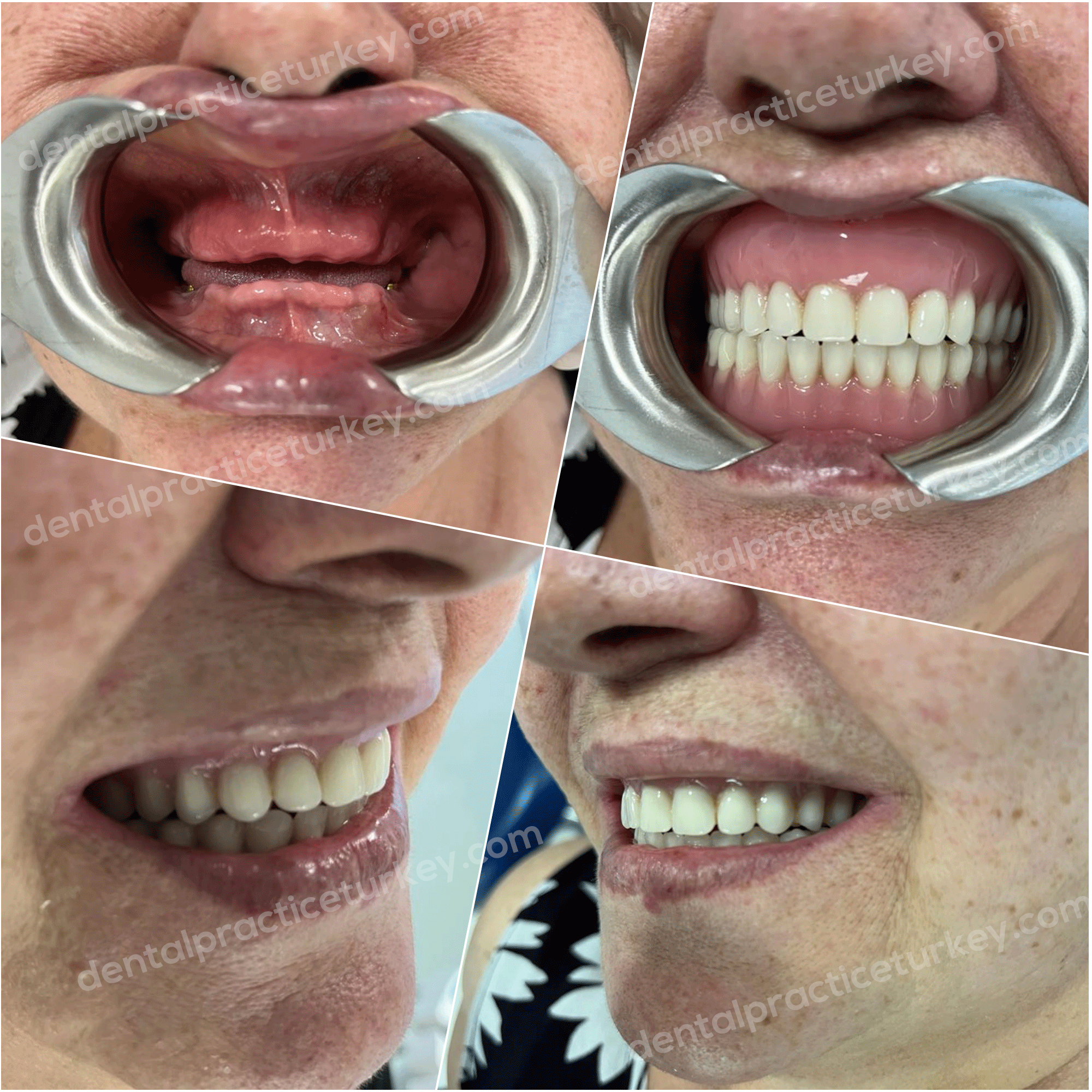 Full Mouth Dental Implants 1